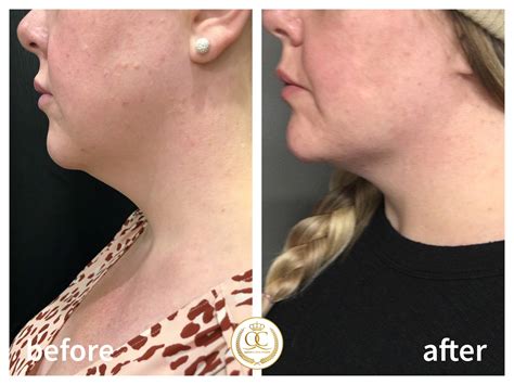 What is Belkyra Treatment .